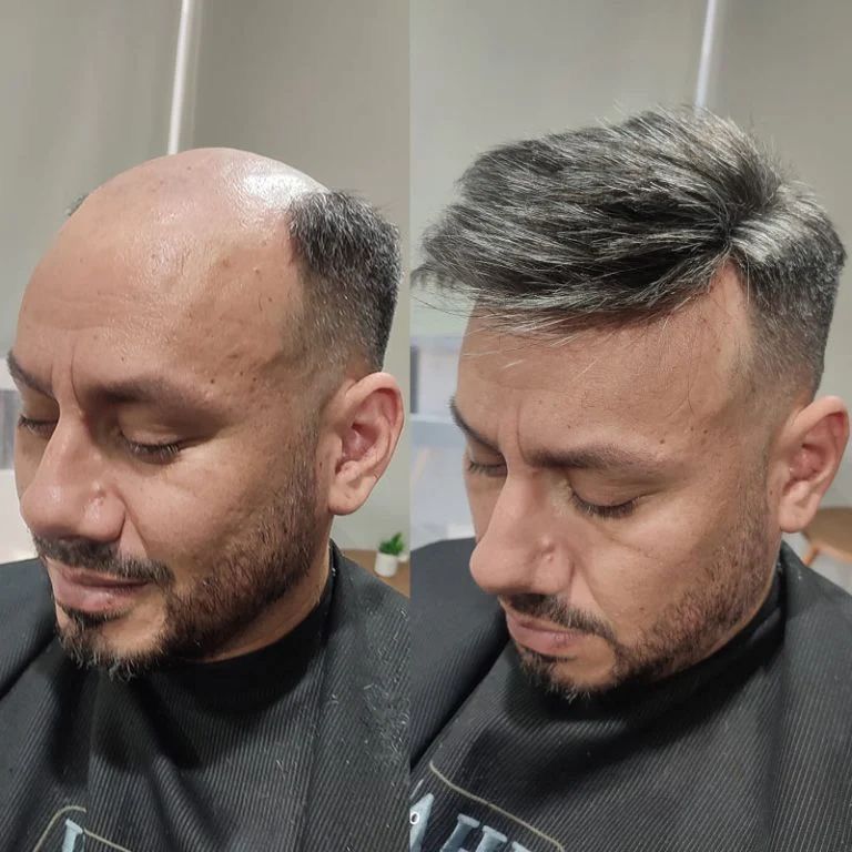 Glamorous Hair Transplant in Dubai | Glam Hair Clinic - FUE Hair Transplant Dubai, FUT Transplant, BioFibre, DHI 2