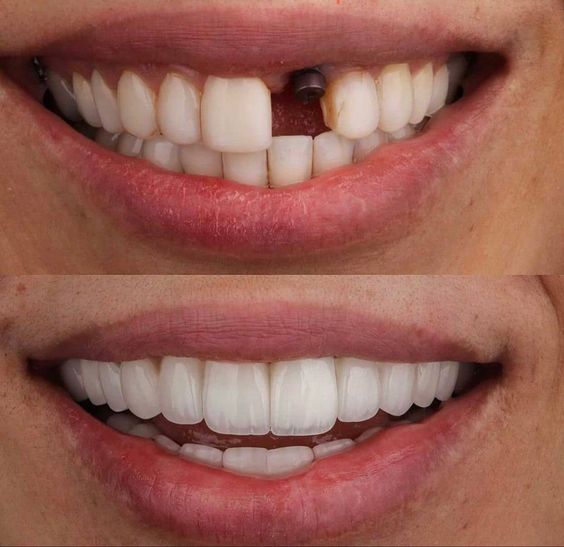 Dr Saulo Fernandes - Facetas de Resina em Duque de Caxias - Implante Dental Duque de Caxias - foto 3