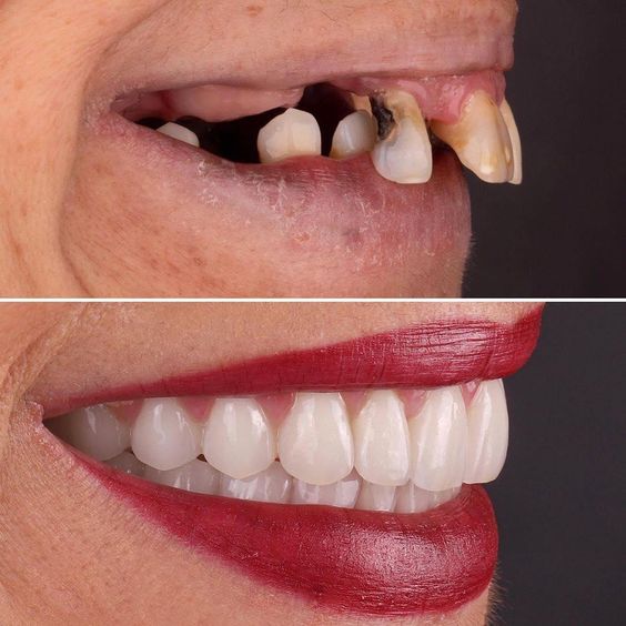 Dr Saulo Fernandes - Facetas de Resina em Duque de Caxias - Implante Dental Duque de Caxias