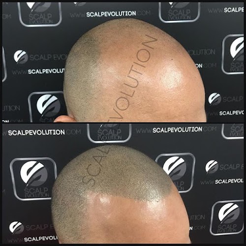 Scalp Evolution - Scalp Micropigmentation Miami SMP - Micropigmentacion Capilar logo