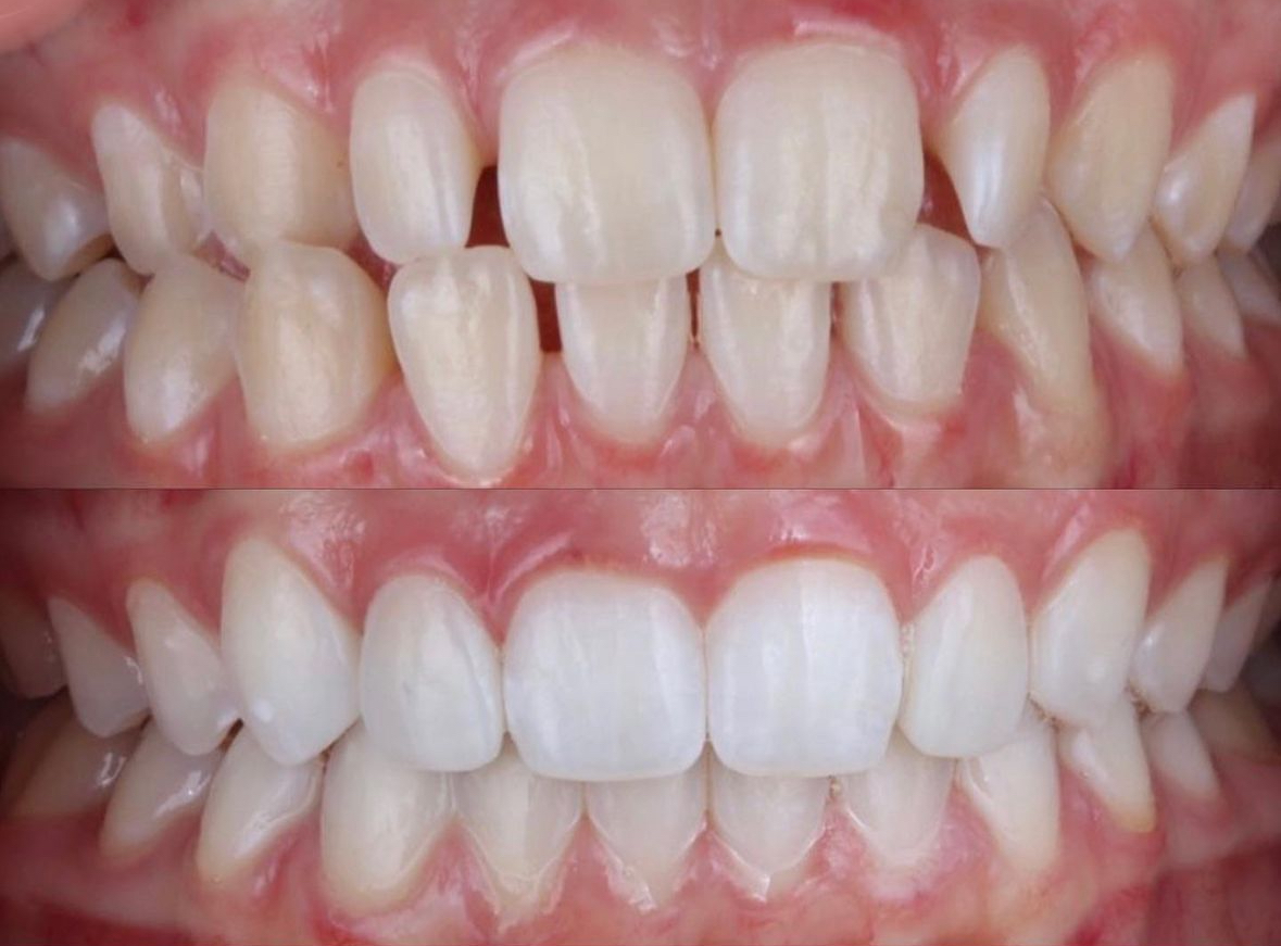 Invisalign Dentist Dubai 3