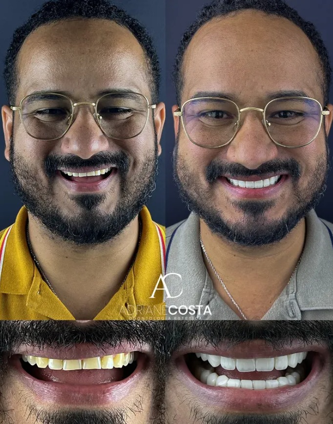 AC Odontologia e Estética | Facetas em Resina | Dentista | Harmonização Facial - foto 2