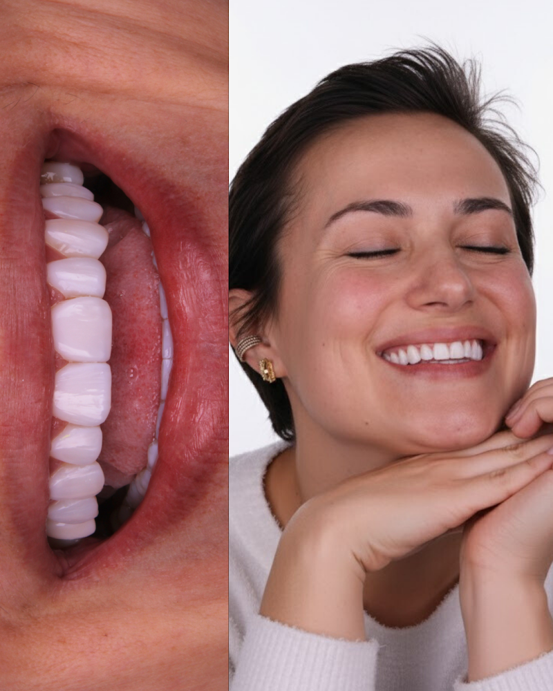 Dra. Vladja Torno | Facetas em Resina Composta em Curitiba - foto 3