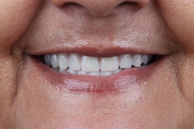 Sempre Sorrindo - Implantes dentários - foto 4