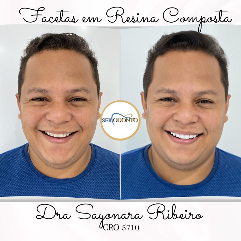 SER ODONTO - DENTISTA - LAGOA NOVA - PREENCHIMENTO LABIAL - HARMONIZAÇÃO FACIAL - BOTOX - ORTODONTIA - foto 3