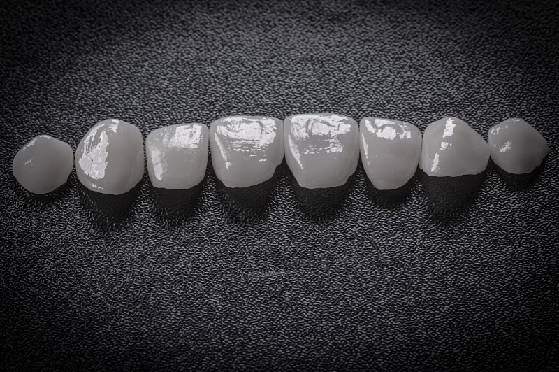 Odonto Liuzzi | Lentes de Contato Dental | Prótese Protocolo | Ortodontia | Periodontia | Implante Dentário | Dental Tourism - foto 5