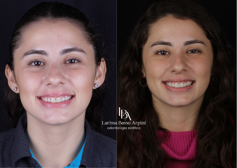 Dra. Larissa Basso Arpini - Dentista Lentes em Resina em Porto Alegre - foto 3