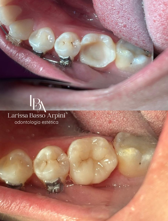 Dra. Larissa Basso Arpini - Dentista Lentes em Resina em Porto Alegre