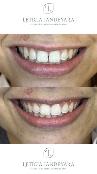 Dra Letícia Iandeyara - Dentista - Ortodontia e Alinhadores - foto 5