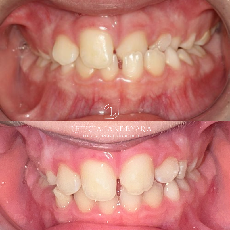 Dra Letícia Iandeyara - Dentista - Ortodontia e Alinhadores - foto 4