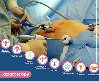 Dr. Sharda Arvind : Gynaecologist & Laparoscopic Surgeon, Mumbai. Fibroids/Endometriosis/Ovarian cyst/Gynaec cancer - Image 3