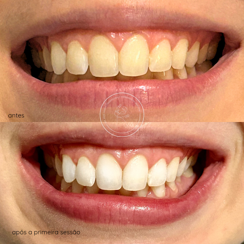 Dentista Harmonização Manaus Preenchimento Labial Dra. Anne Sadala - foto 3