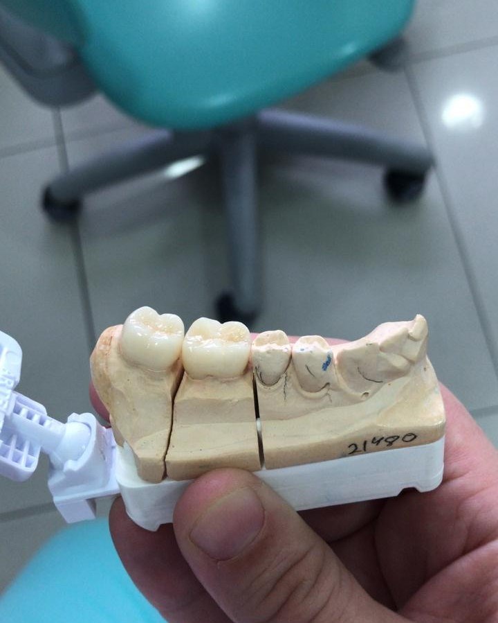 Dr Marcelo Palma | Dentista em Campinas | Implante, facetas, canal, clareamento, restauração, extração de siso. - foto 3