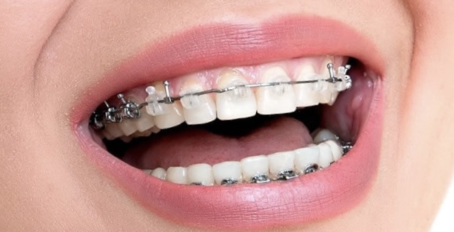 Dra. Tamiris Glaychman • Ortodontia | Clareamento dental | Botox l - Freguesia de Jacarepaguá - foto 5