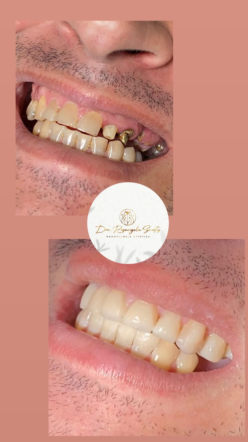 Dra. Rosangela Santos | Dentista em Maceió | Facetas em Resina em Maceió - foto 2