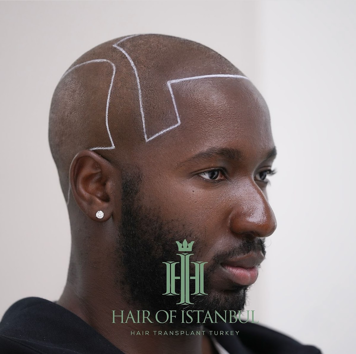 Hair of Istanbul Dubai - Hair Transplant Clinic
