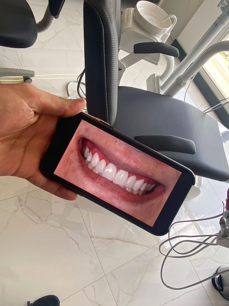 Light Smile - Facetas em resina em São Luís - foto 3