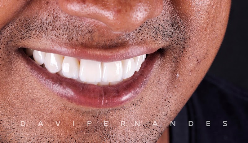 Light Smile - Facetas em resina em São Luís - foto 4