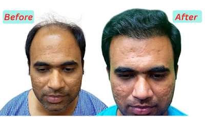 Vinoda Hair Transplant Clinic