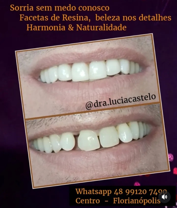 Clareamento Dental & Facetas - foto 2