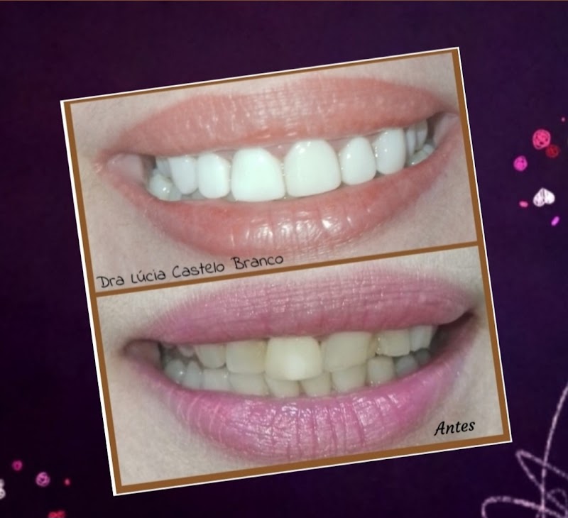 Clareamento Dental & Facetas - foto 4