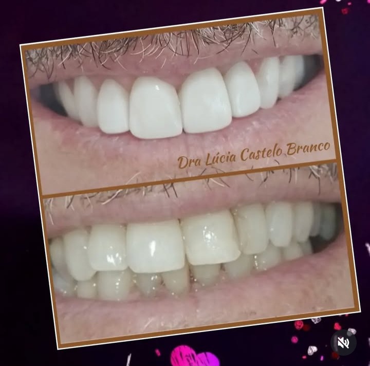 Clareamento Dental & Facetas - foto 3