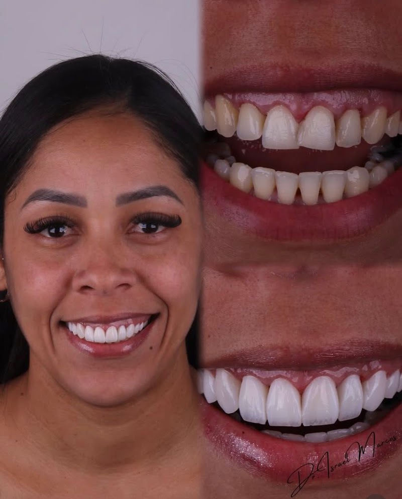 BM Odontologia - Lentes em Resina - foto 2