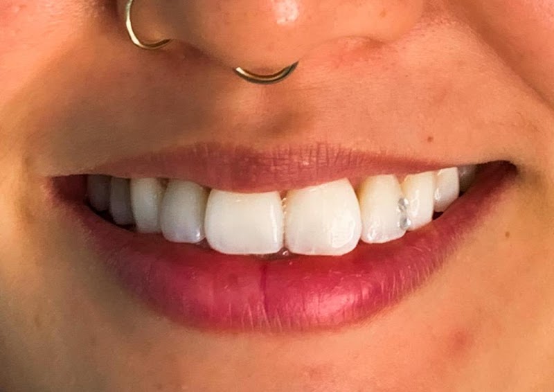 Dra. Ariane Gutiérrez | Tratamento de Canal com Microscopia | Sedação Consciente - foto 4