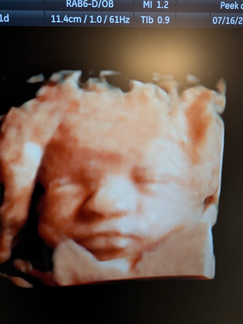 Peek a boo 3D Ultrasound
