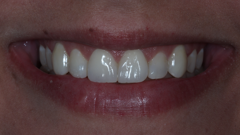 Dra. Ananda Jasson- Dentista. Tratamento de canal- Clareamento dental- Prótese Dentária- Cirurgias-