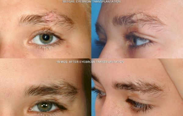 Enfield Royal Hair Transplant Dubai | Exsosomes, PRP , Hair Loss Treatment 4