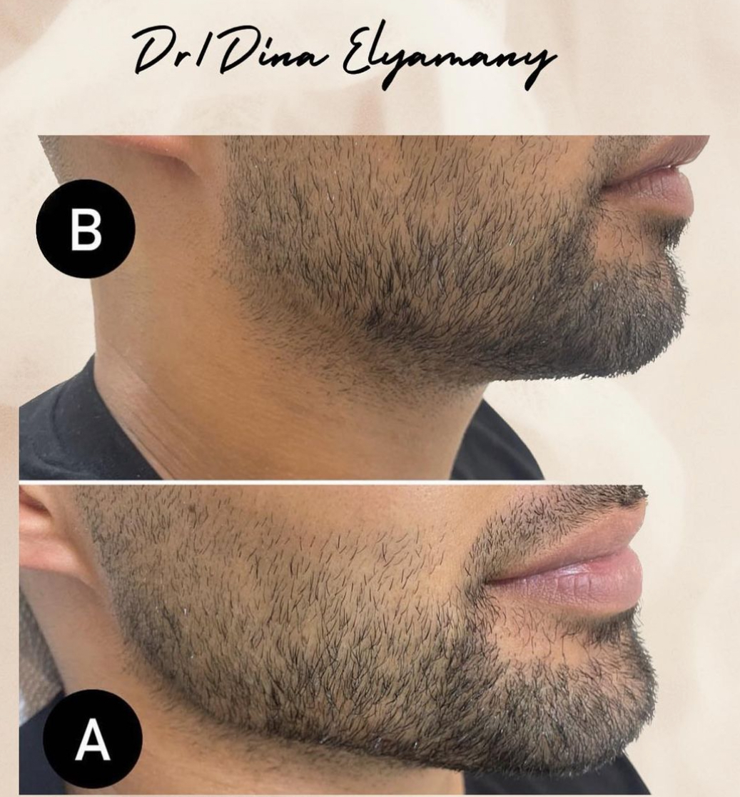 Enfield Royal Hair Transplant Dubai | Exsosomes, PRP , Hair Loss Treatment 5