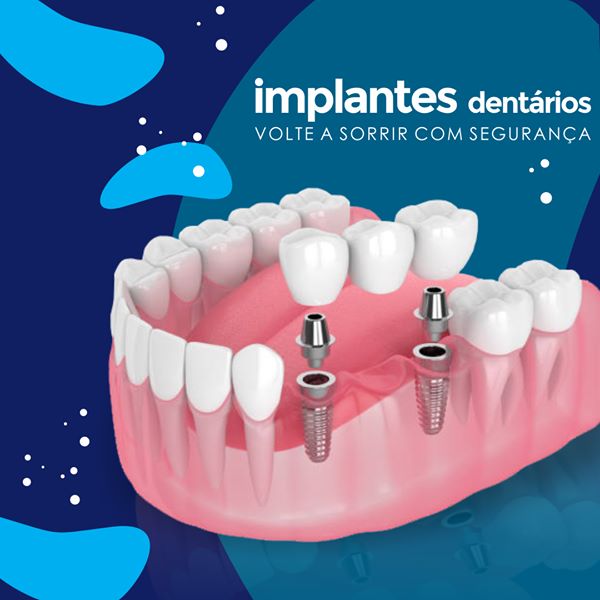 BeloImplante - Cidade Alta