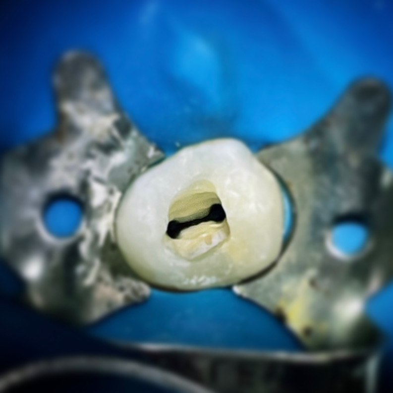 Dra. Paula Amaral - Endodontia - Canal - Clareamento - foto 5