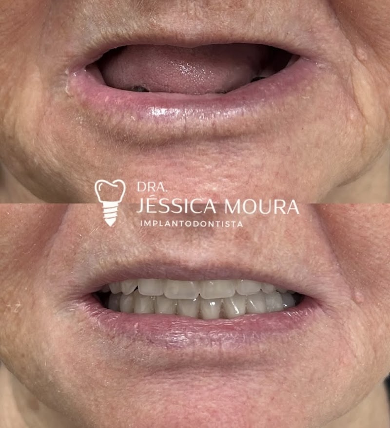 Dra. Jéssica Moura - Implantes Dentários - foto 5