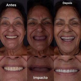 Implante Prótese tipo Protocolo - Madureira - Rio de Janeiro