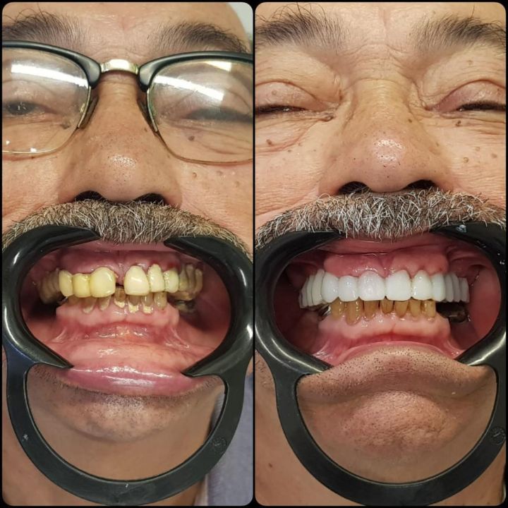 Implante Prótese tipo Protocolo - Madureira - Rio de Janeiro - foto 5