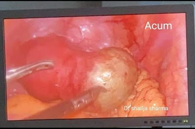 Dr. Shailja Sharma (Ex-AIIMS & Safdarjung hospital New Delhi) | Best Gynaecologist in Agra | Gynecologist in Agra - Image 3