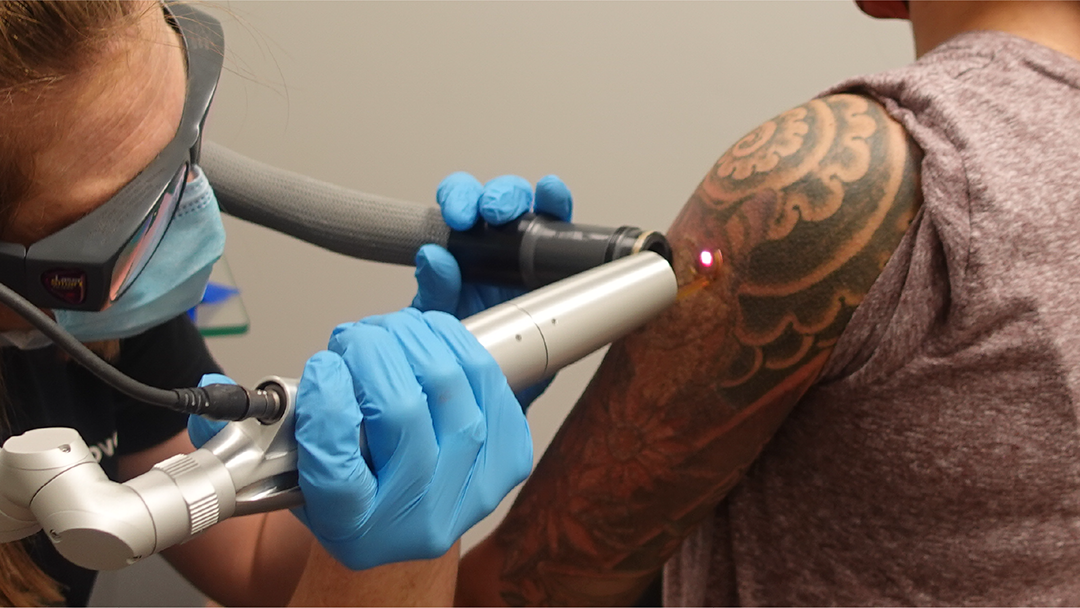 Removery Tattoo Removal & Fading tattoo work — photo 3