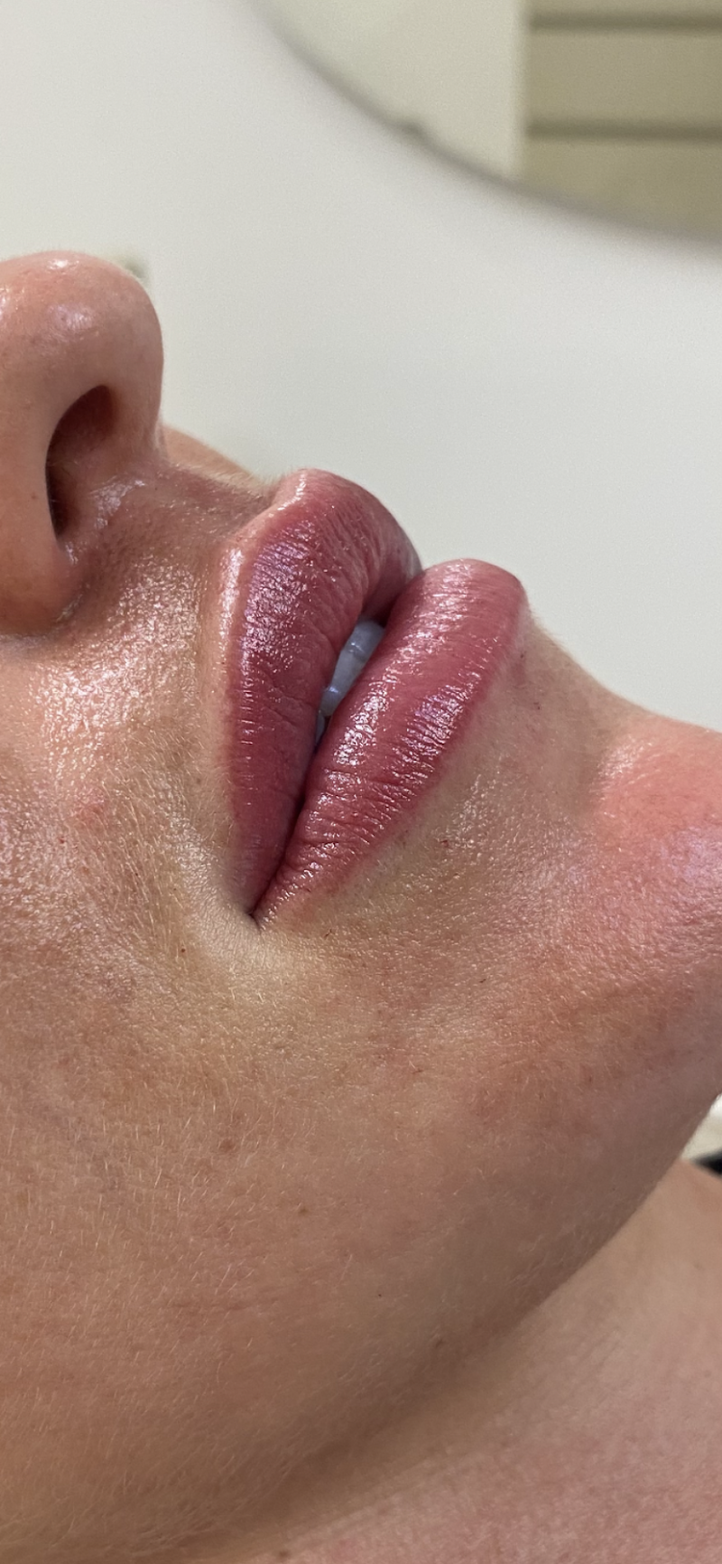 Dra Paola Brito harmonização facial - foto 3