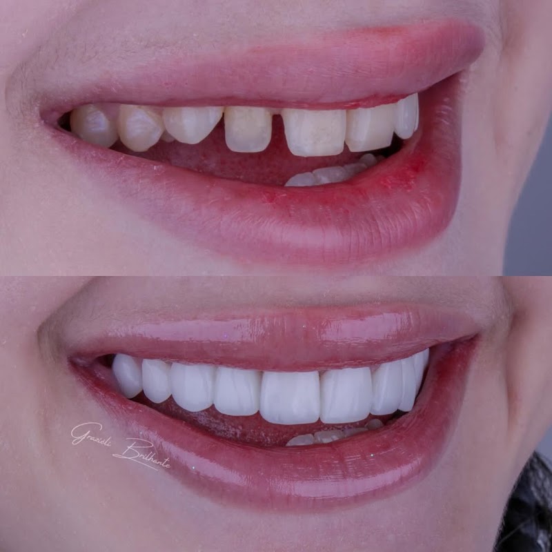 Dra. Graziéli Brilhante | Lentes de Resina em Joinville - foto 2