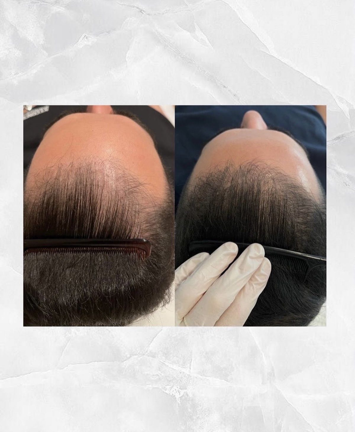 LEJOU DUBAI PRP HAIR 5