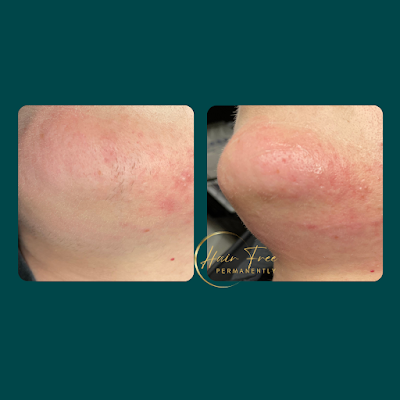 Hair Free Permanently photo 3