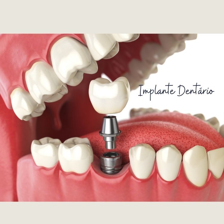 Implant Class - foto 2