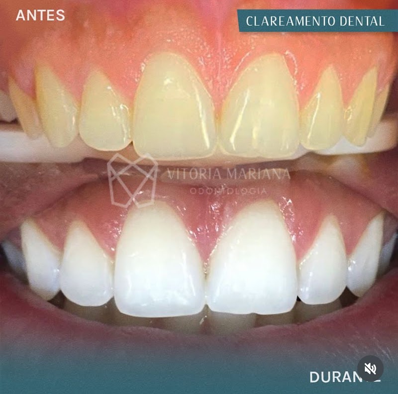 Dra. Vitória Mariana | Dentista Aracaju | Aparelho Invisível e Clareamento Dental - foto 5