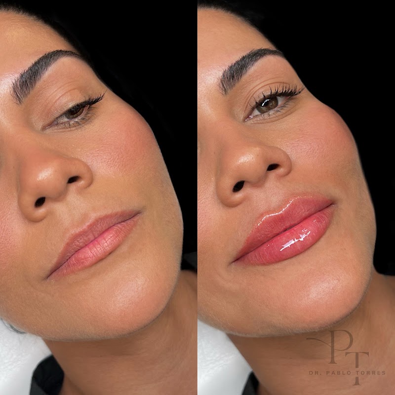 Dr. Pablo Torres | Aumento de Labios en Vigo photo 4