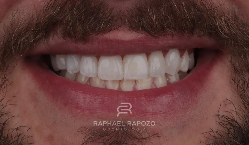 Implantes Dentários em Niterói | Dr. Raphael Rapozo I Dentista Niterói I Facetas - foto 2