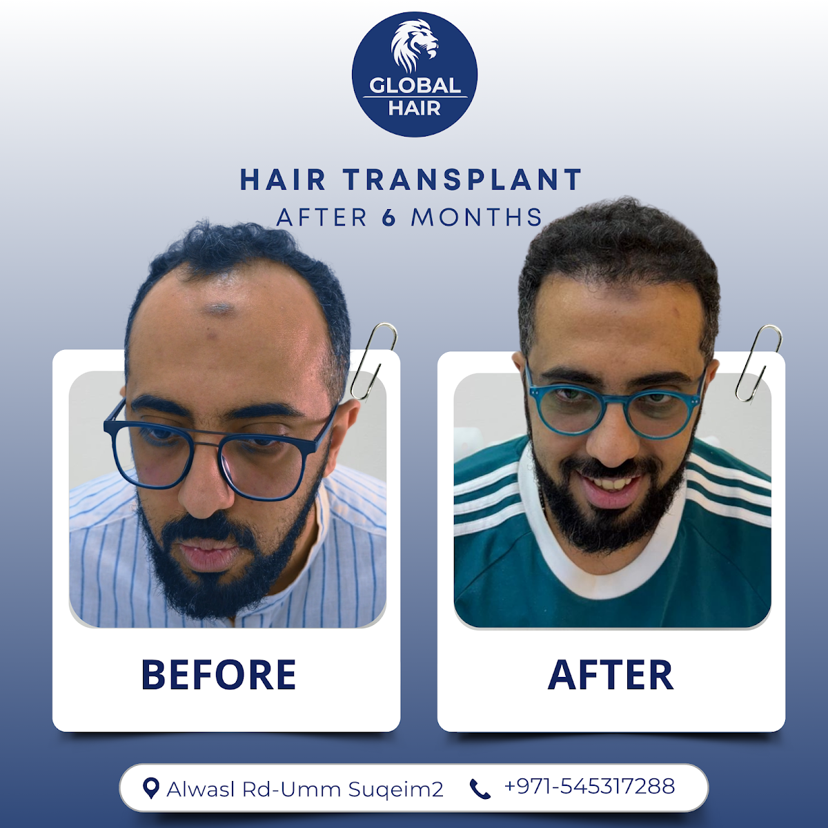 Global Hair Centre Dubai 3