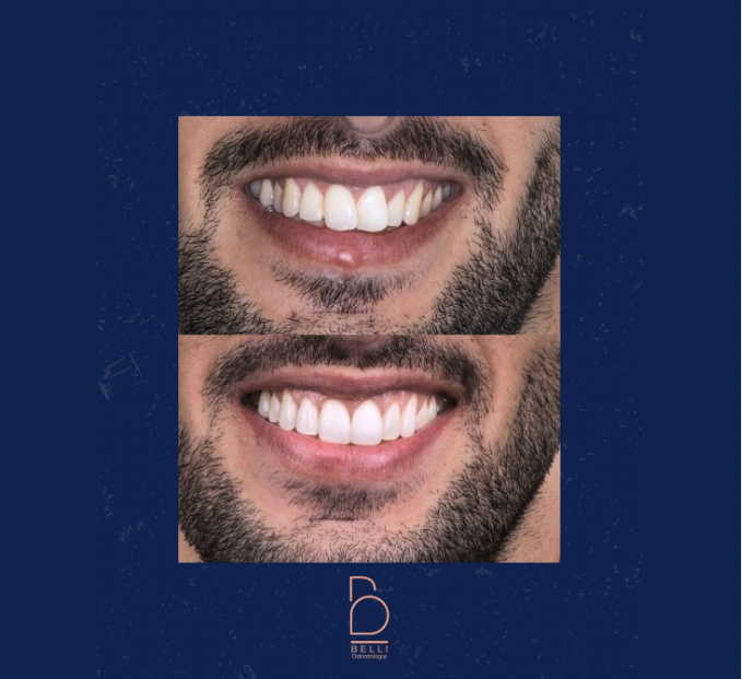 Dra. Amanda Romano - Tratamento ortodôntico | Alinhadores invisíveis | Alinhadores estéticos em Goiânia - foto 5