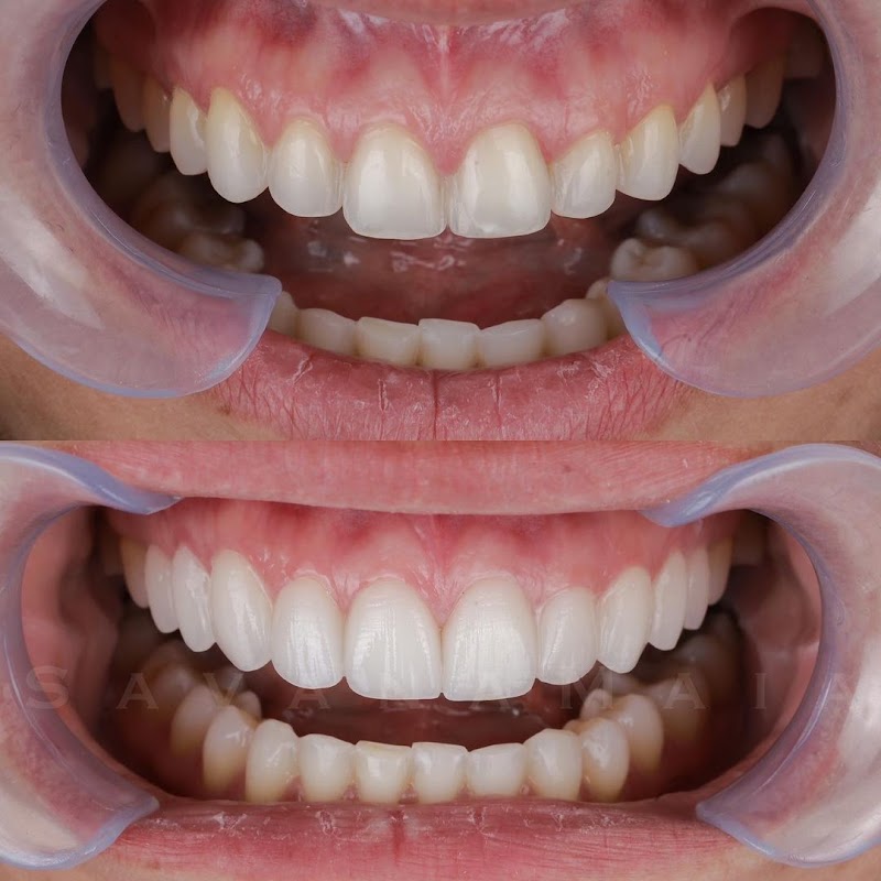 Odontologia Savana Maia - Lente de Contato Dental - Invisalign - implante dentário - foto 2